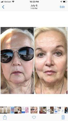 Microneedling at its finest!