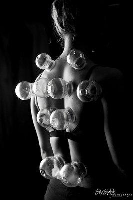 Cupping Therapy