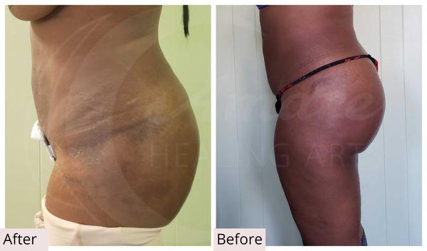 Lipo and BBL post op 48 hrs after surgery. 8 Manual Lymphatic Drainage sessions, 8 days in a row. Fully healed in 1&1/2 months