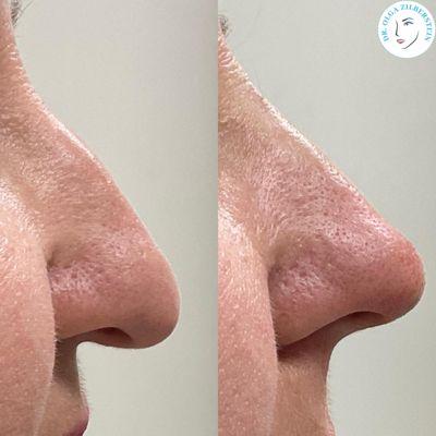Non-surgical nose job