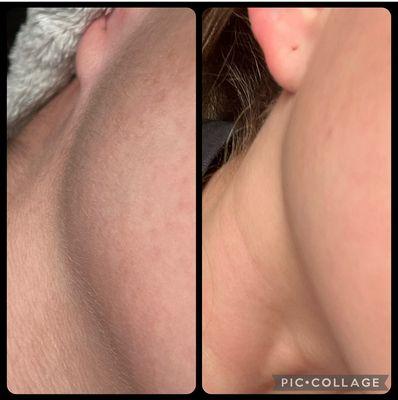 Before, and after my dermaplane facial