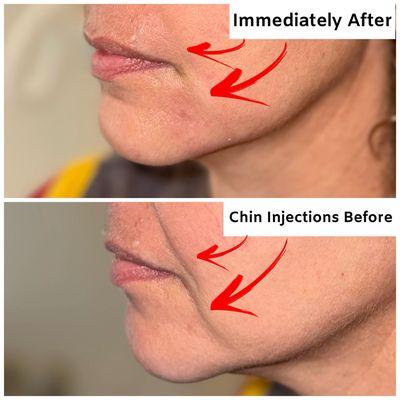 Juvederm, Versa, Restylane, Botox, chin fillers, jawline fillers, injectables, injections, lip fillers, smile lines