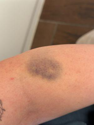 The bruise from the blood test