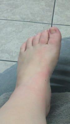 Dont mind my ugly unpolished feet at the moment..Looks like with the $40 pedi, it came with a side of 1st degree burn!