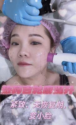 Thermage FLX face lifting