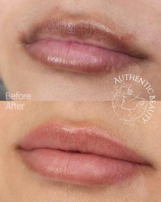 Healed Lip Neutralization