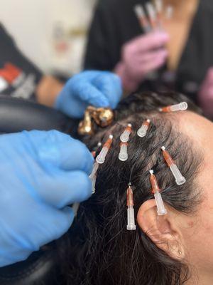 Hair Rejuvenation with PRF and smooth threads