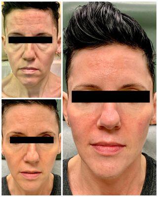 One of my all time favorite transformations. Thank you for trusting me with your beautiful face!