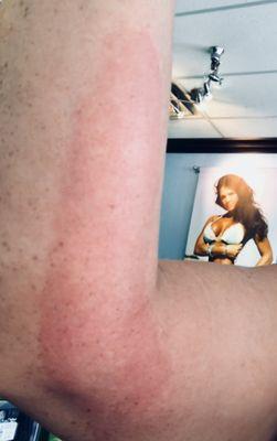 Multiple chemical burns from the bed. The employee said they're changing products next week with no apologies, let alone any compensations.