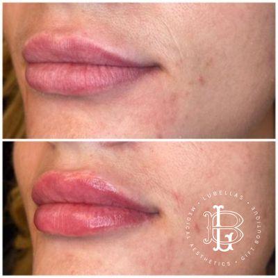 Lip Filler Benefits: Restore previous lip size. Correct the shape of your lips. Boosting confidence. Smooth wrinkles.