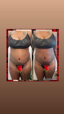 One session of Cavitation 360 with RS