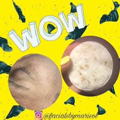 facials balck heads remover