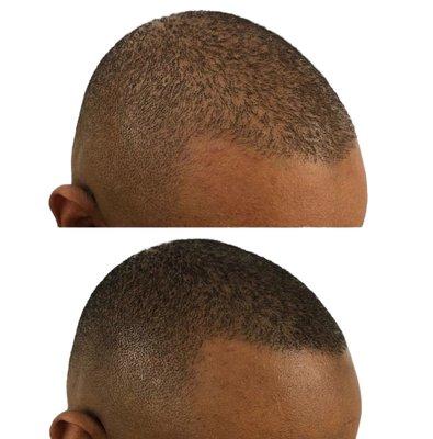 Restoration Hairline Seattle