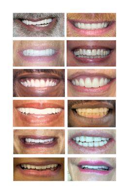 Smile transformation collages  (with and without whitening).
