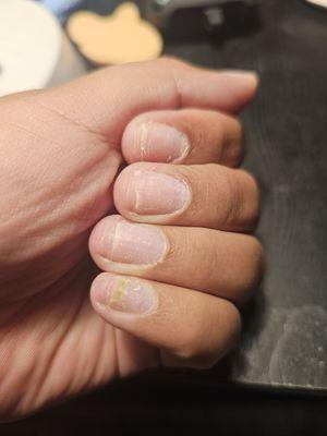 Bacterial infection caused by using compromised equipment