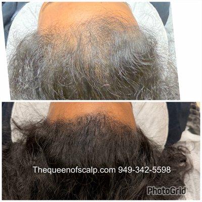 When done correctly, you can get amazing density results like this, after 3-4 sessions.