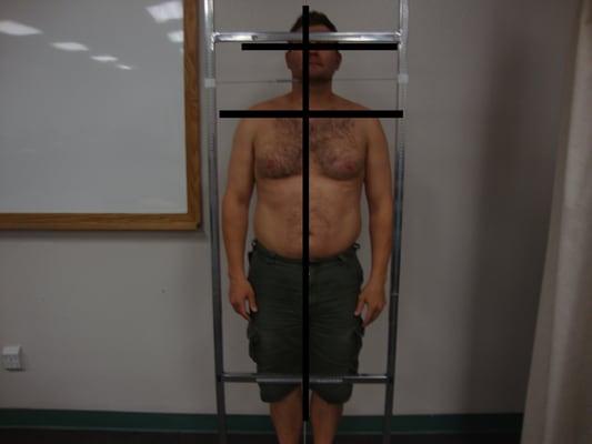 Before first visit. he leans to his left, shoulder is not leveled. Neurological symptoms develop (tremor to both fingers and hands.)