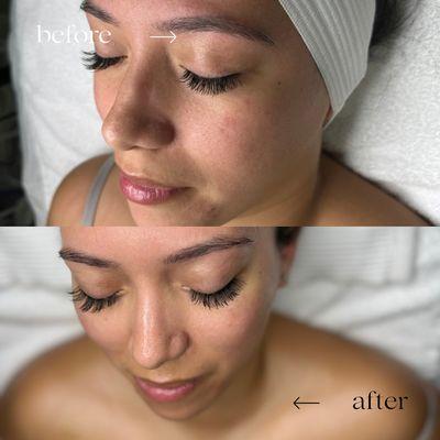 Before and after using Lira Clinical Mystiq Elite Treatment.