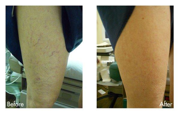 Varicose Veins Before and After Treatment