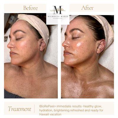 Same day results! OMG peel !! BioRePeel