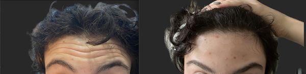 Botox Xeomin works wonders for my younger clients, delivering even better results for a refreshed and youthful glow!