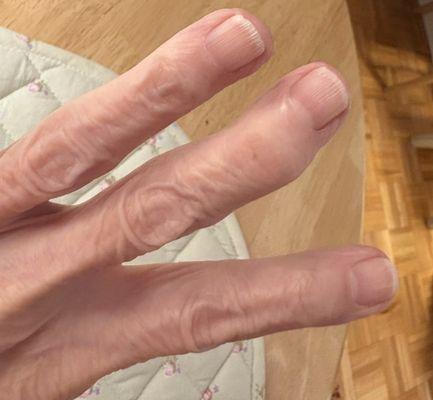 Until now this was my only arthritis in my left finger. All of my mother's fingers looked like this. 09/06/25