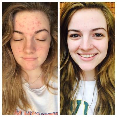 Before and after acne treatment.  First picture taken in August 2014 and second picture taken in June 2015.