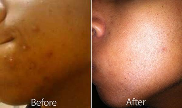 Acne? No problem. Dabbo can help.