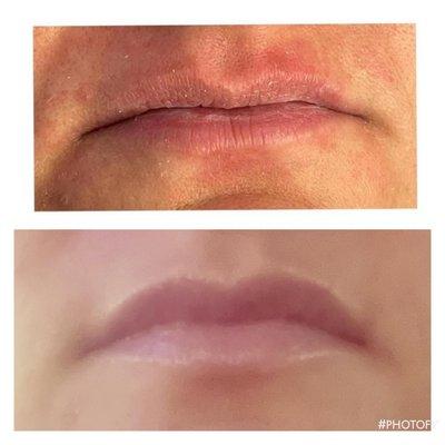 Before and After Revanesse Lips+
