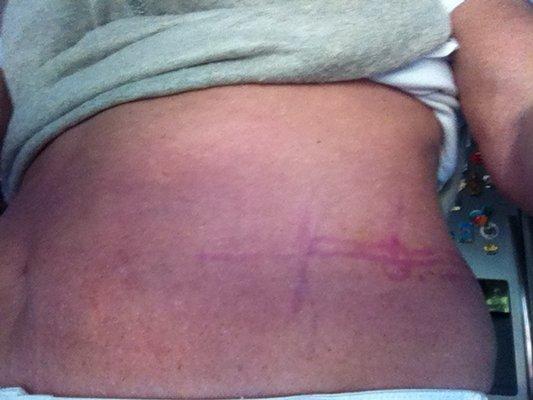 Physician Assistant Ashley S. Wilson used markers that didn't come off after 4 days.