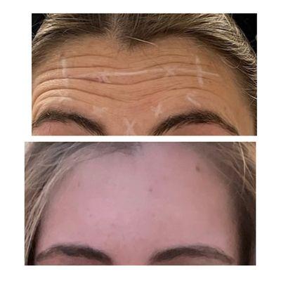 14 days after this babe got Botox for the first time. No more fine lines at rest or deeper wrinkles when lifting brows.