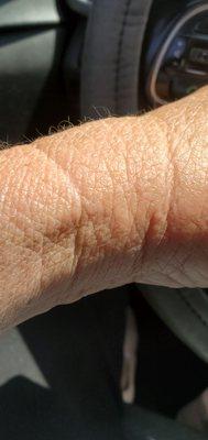 Where 1 needle was in my hand... instantly swollen, she said it's not swollen, I know my body.. it's sore and swollen.