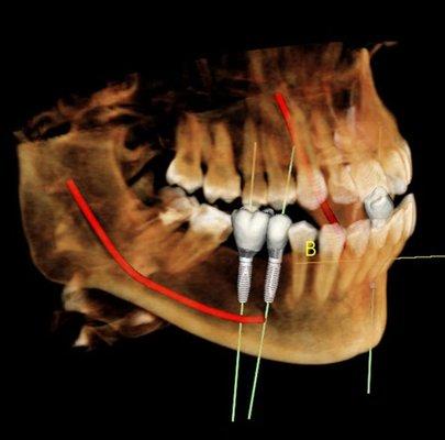 Sample CT Scan - Implant simulation with mandibular canal for accurate implant placement.