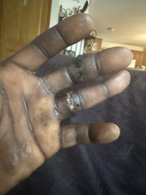 My cut up two fingers that I will never be able to use for the rest of my life