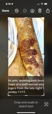 Bruises on a patient's arm (Nov 17, 3024) done by an aide with a very strong aide. Thid may be the result of unnecessarily rough treatment.