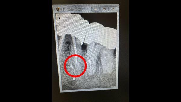 Tooth with AIR GAP Present on Root Canal