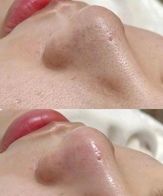 Extraction facial Before & after