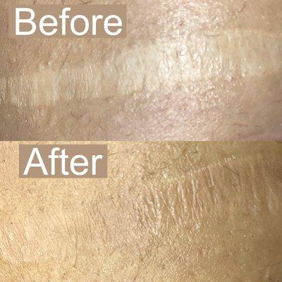 Scar Camouflage Tattoo www.NalaCosmetic.ink