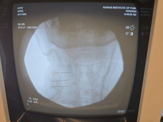 3 long needles all at the same time deep into my neck while I was balancing on my nose face down on the table-SCREAMING-no empathy at all