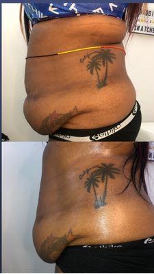 Clients 1st session of cavitation,vacuume therapy,and rf skin tightening on stomach and waist