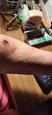 Wound