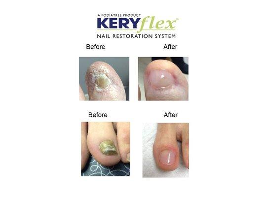 1-hour transformation of any nail deformity