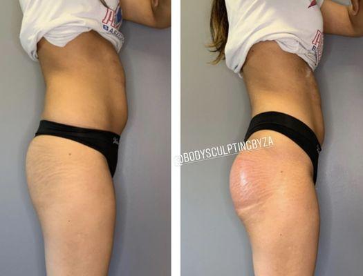 Body contouring (non surgical) butt enhancement/lipo laser (non invasive)