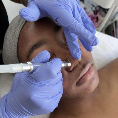 Microdermabrasion Facial