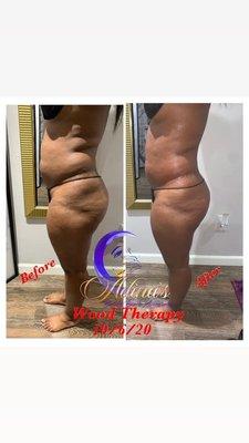 Before & After Results of Wood Therapy! Let's get Sculpted
