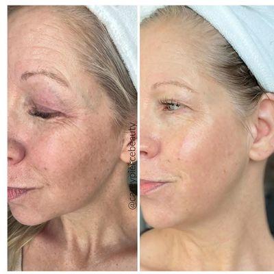 Cellstory resurfacing results