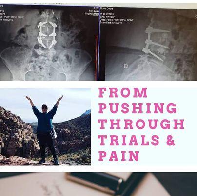 Victory post 3 surgeries. Thanks to Meline Law, I can walk again.