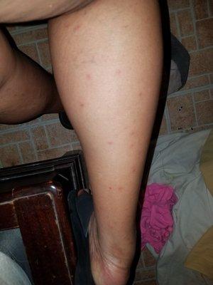 All the bedbug bites...