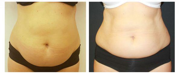 body contouring