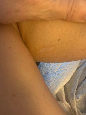 This was a very small mole. And the incision did open up a couple days later and he added sutures at that point .